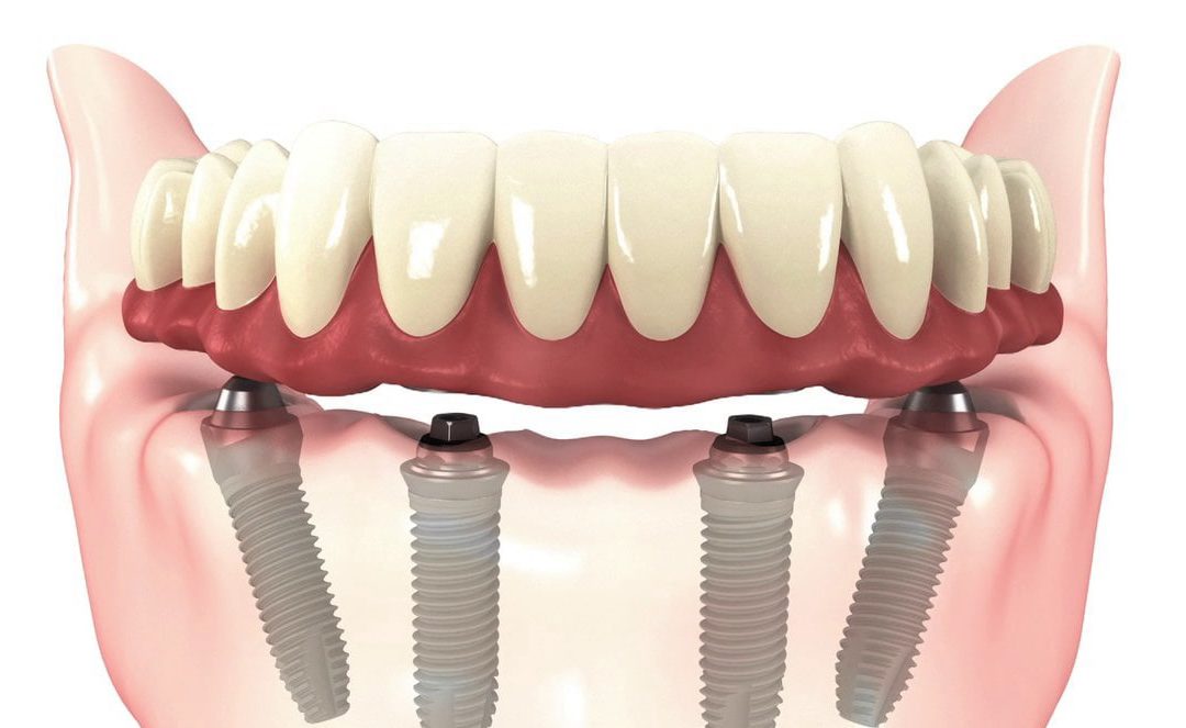 Implantes Dentais
